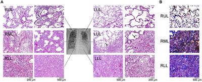 Immune Cells Profiles in the Different Sites of COVID-19-Affected Lung Lobes in a Single Patient